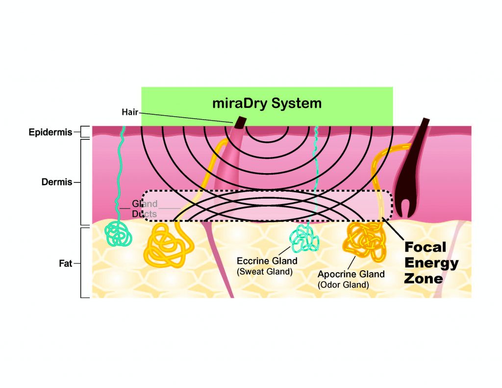 miraDry Hyperhidrosis UK